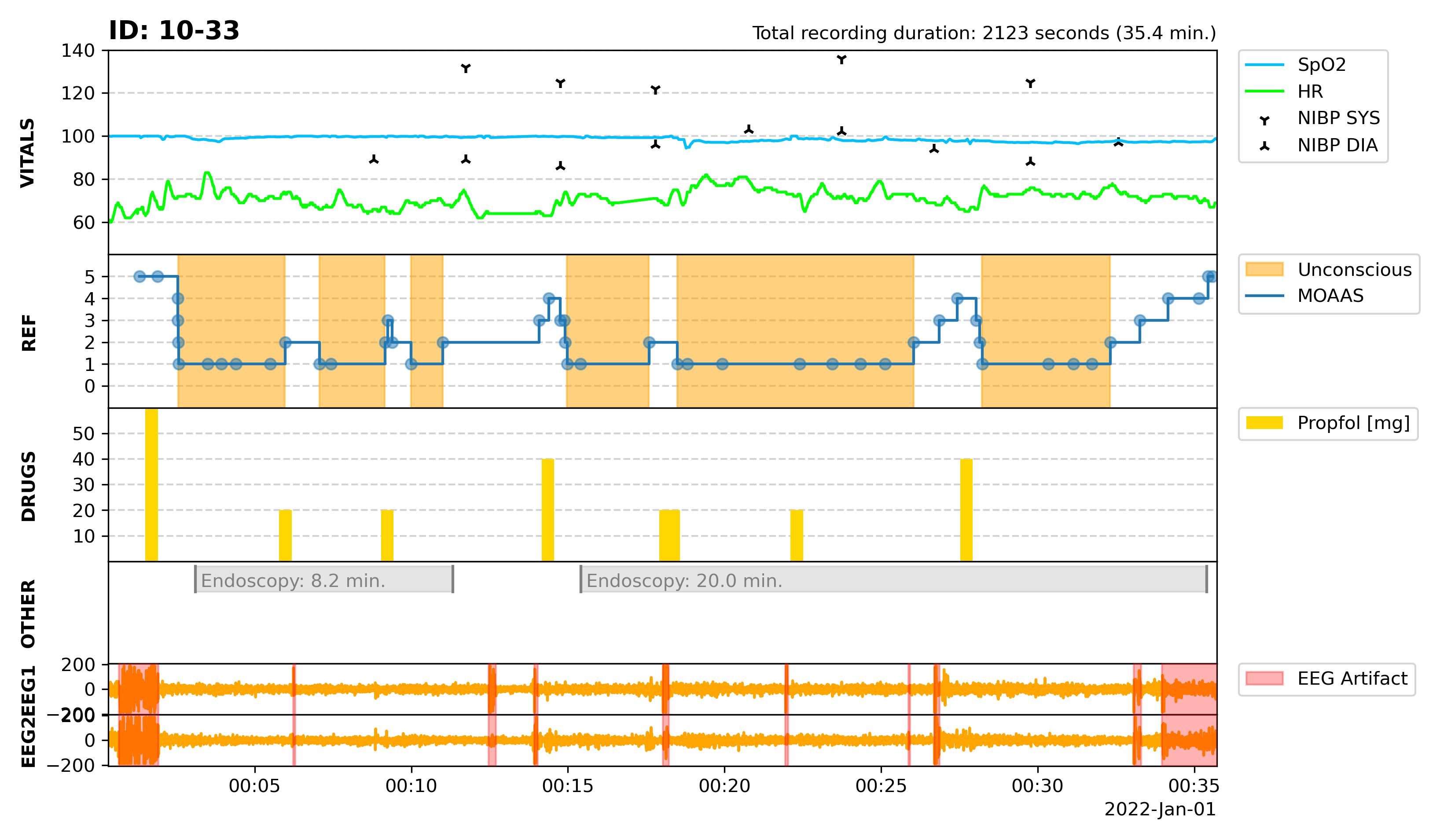 EEG plot from recording 10-033